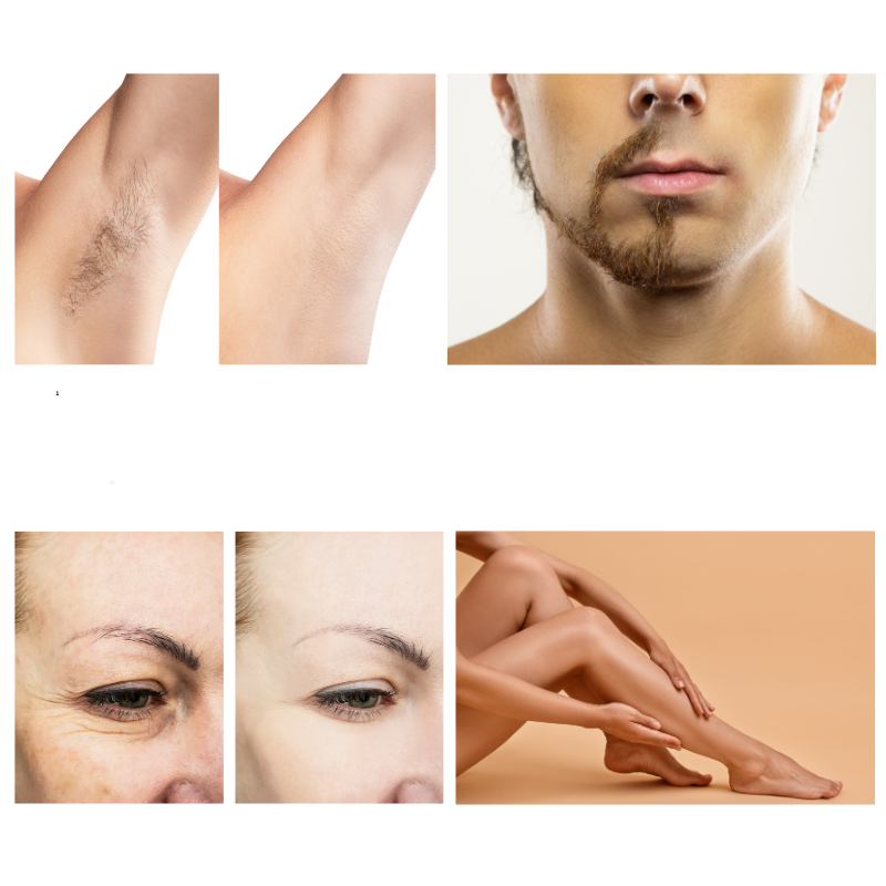 SmileSkin IPL- Haarentferner