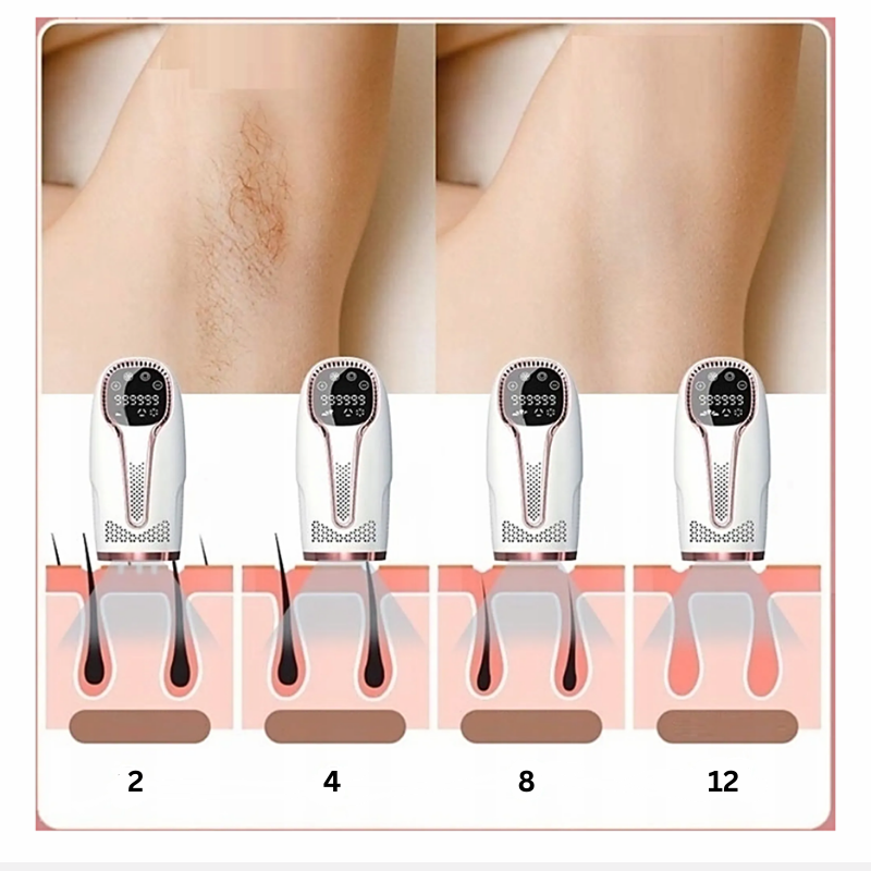 SmileSkin IPL- Haarentferner